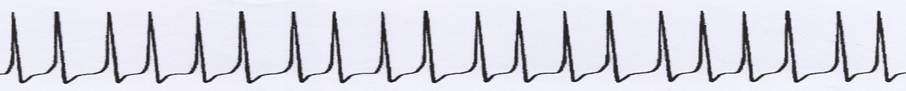 Origin of single signals (continuous signals) from an uninterrupted sequence of action potentials