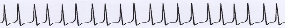 Origin of single signals (continuous signals) from an uninterrupted sequence of action potentials